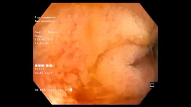 Water Jet Ileoscopy. Подводная илеоскопия