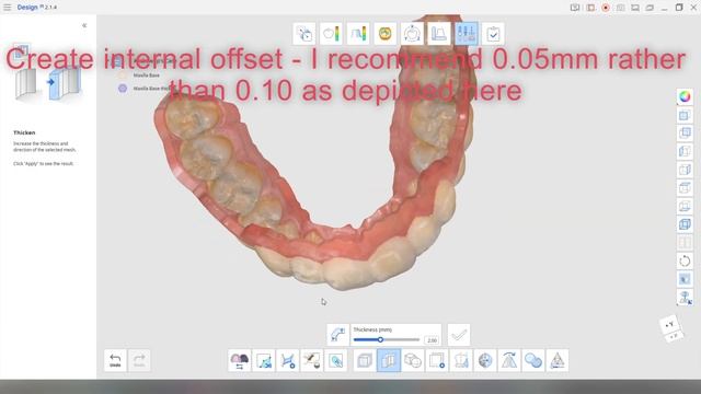 Directly 3D printed mouthguard/bleaching tray - design and fabrication смотреть онлайн