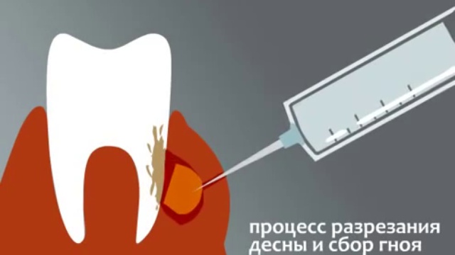 Флюс. Лечение флюса