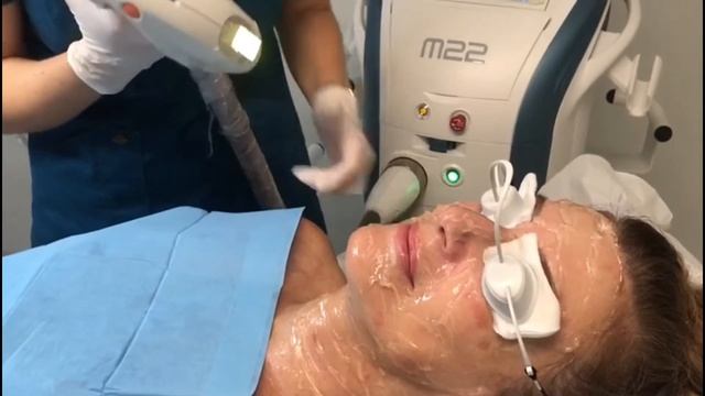 Láser IPL M22 Lumenis Clínica Isturitz смотреть онлайн