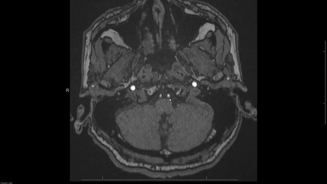 MRA (magnetic resonance angiogram) head radiology search pattern смотреть онлайн