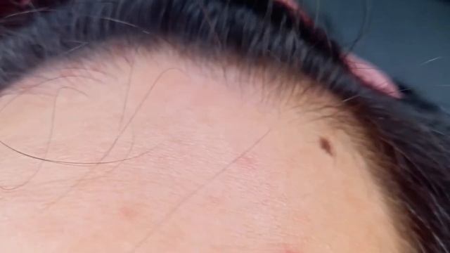 E2 ▪ HAIR TONIC MINOXIDIL 15% REVIEW IN ONE MONTH / ALCOHOL BASE смотреть онлайн