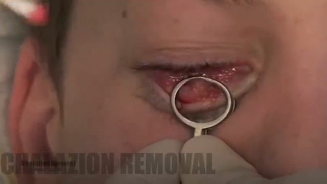 Chalazion Removal смотреть онлайн