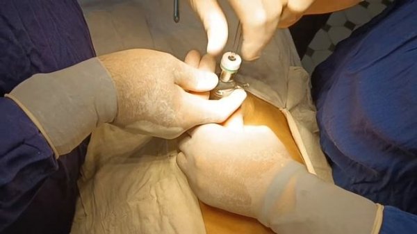 Лапароцентез техникаси