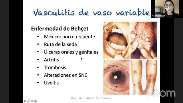 Vasculitis ENARM 2020 - Dra. Azalea Rojas смотреть онлайн