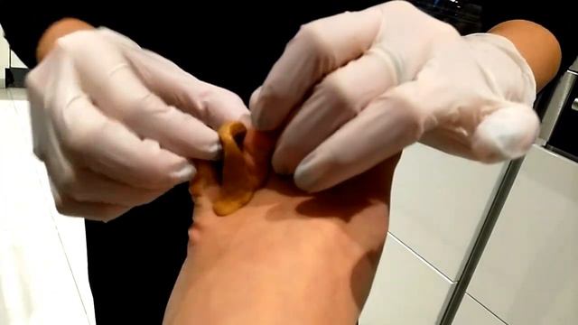 Изготовление ортеза для предотвращения межпальцевой двойной мозоли. Часть 2 смотреть онлайн