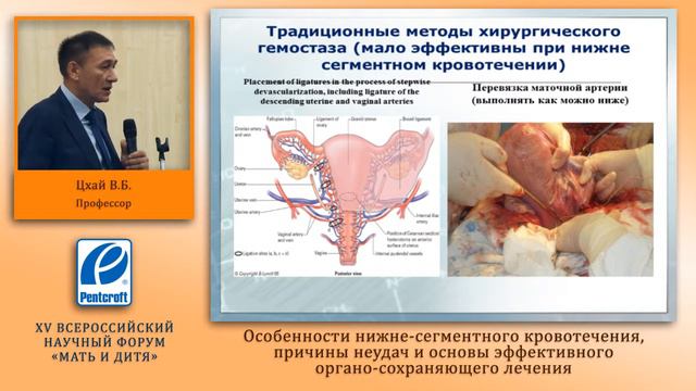Особенности нижнесегментного кровотечения, причины неудач и основы лечения, проф. Цхай В.Б., 2014 смотреть онлайн