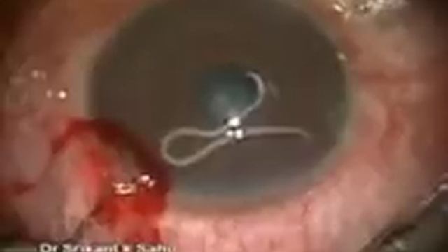 Червь в глазу