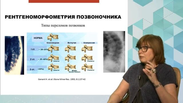 Боль в спине: А может это остеопороз?. 10.07.19 смотреть онлайн