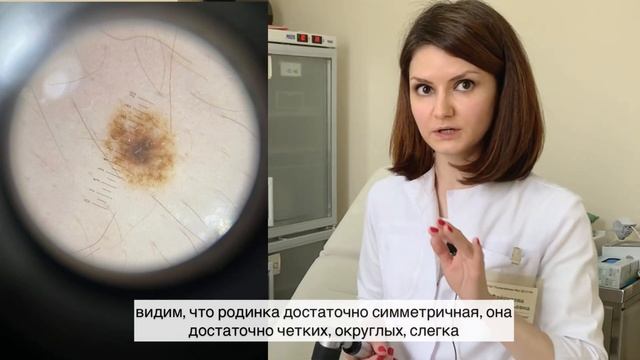 Как отличить родинку от меланомы? Хорошие и «плохие родинки»|Врач-дерматовенеролог Файрузова Ю.Ю. смотреть онлайн