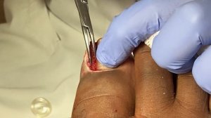 FESTERING Infection from INGROWN TOENAIL !  You should SMELL this one!