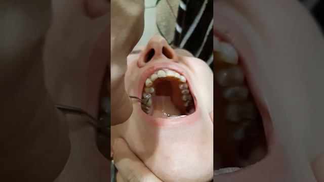 Продолжение. УДАЛЕНИЕ ПЛОМБЫ ИЗ ЗУБА ДОМА САМОСТОЯТЕЛЬНО 20190102 200927 смотреть онлайн