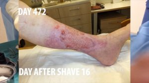 570 дней! Лечение трофической язвы