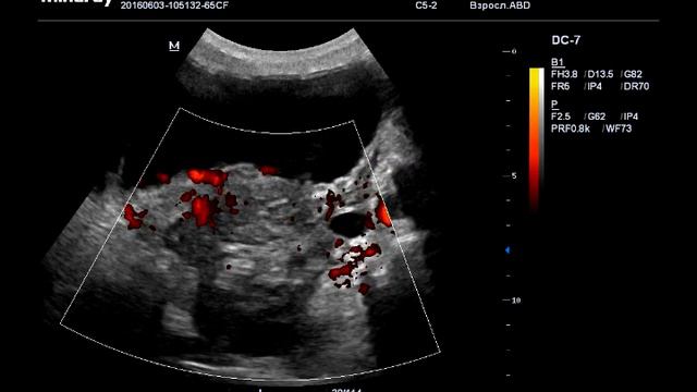 Гидронефроз и не только смотреть онлайн