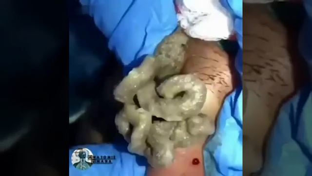 Большой гнойник смотреть онлайн