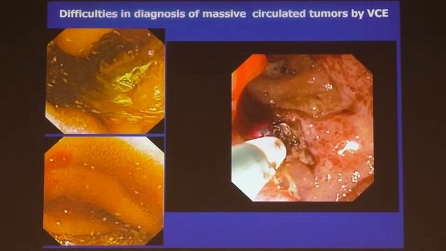 14 Иванова ЕВ Эндоскопия тощей и подвздошной кишки смотреть онлайн