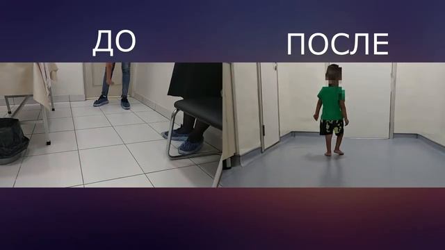 Видео результат метода Понсети смотреть онлайн