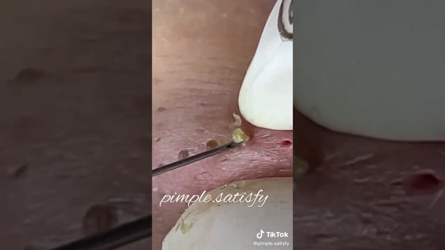 Best Of Pimple Popping TikTok Compilation Part 2 - Satisfying/Best/Relaxing Blachead Removal Video смотреть онлайн