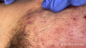 Blackhead Extractions With Draven