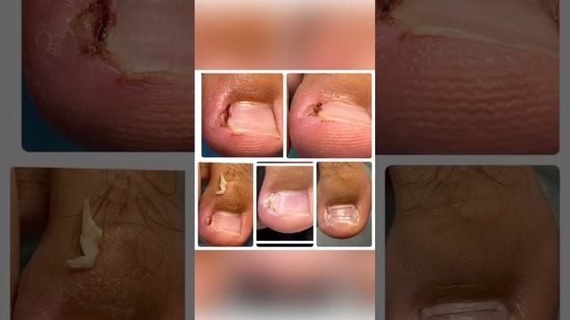 Вросшие ногти у детей и подростков смотреть онлайн