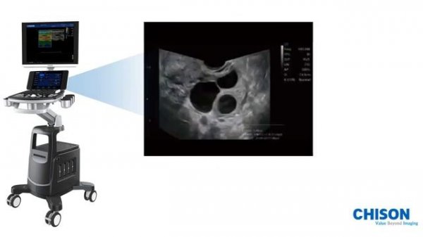 QBit 10 от CHISON (CBit 8): аппарат УЗИ высокого класса для Общих исследований