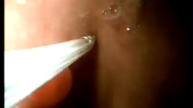 SVideoэндоскопия желудка .wmv смотреть онлайн
