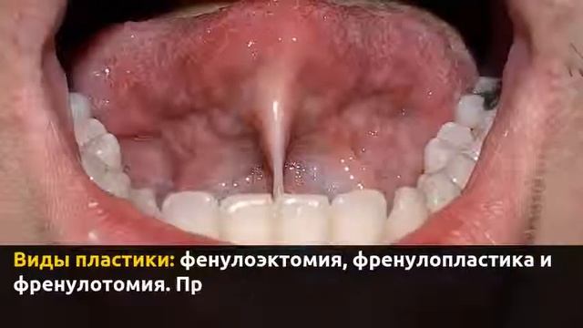 Пластика уздечки языка смотреть онлайн