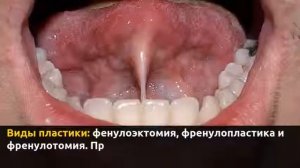 Пластика уздечки языка