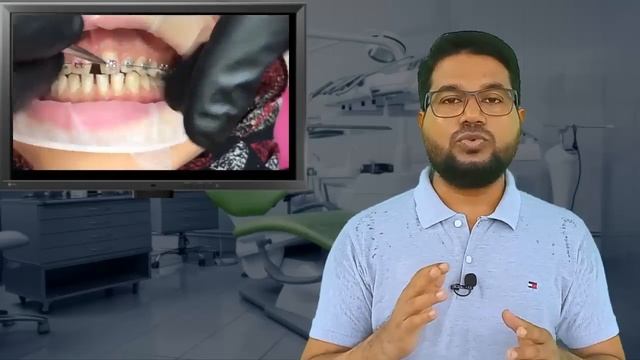 দাঁতে ব্রেস পড়ানোর খরচ কত টাকা || Orthodontics braces treatment cost ||dental brace.by smile bd. смотреть онлайн