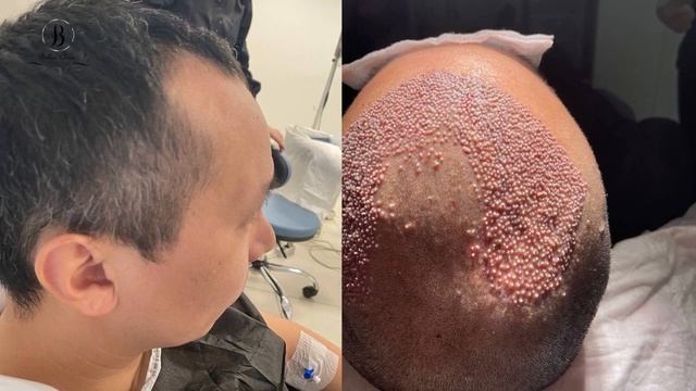 Hair transplant in Bellus clinic смотреть онлайн