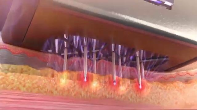 Morpheus 8 («Морфеус 8») – инновационная процедура. смотреть онлайн