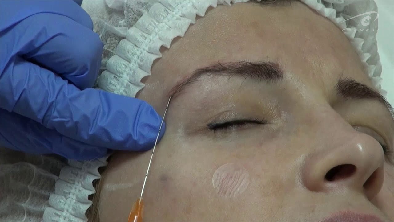 Коррекция брови канюлей смотреть онлайн