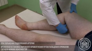 Остановка наружного кровотечения путём пальцевого прижатия сосудов нижних конечностей
