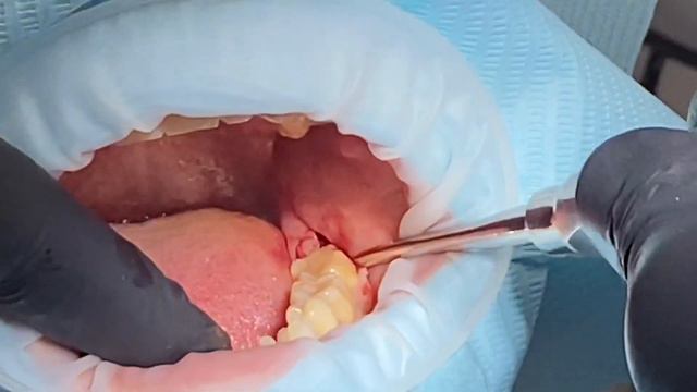 Видалення ретинованого зуба «мудрості» на нижній щелепі смотреть онлайн