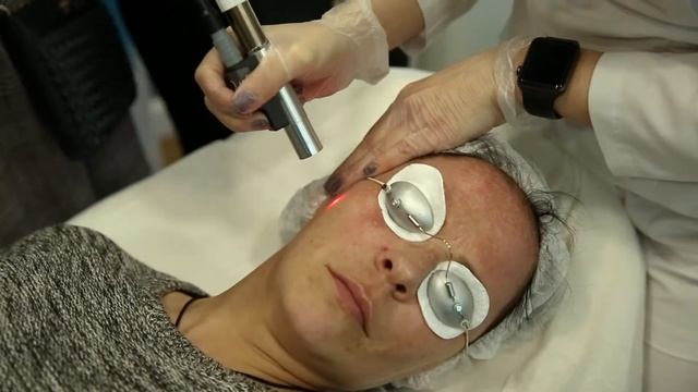 Лазерная терапия нежелательной пигментации смотреть онлайн