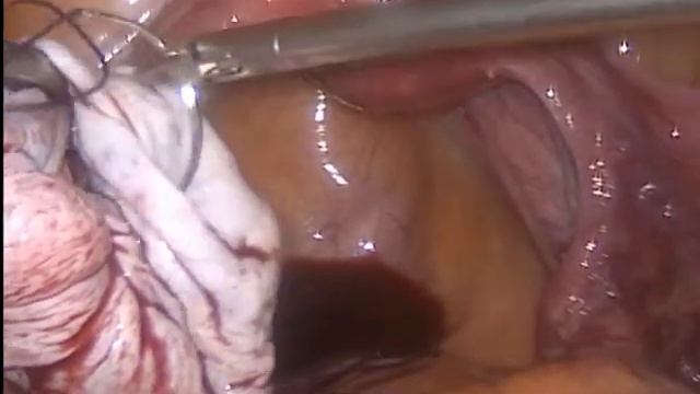 Удаление большой кисты с ушиванием яичника смотреть онлайн