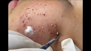 Remoção de cravo 2021 - Pimple Popping 2021- Blackhead Removal 009