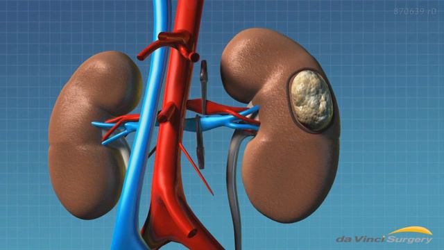 Robotic DaVinci partial nephrectomy смотреть онлайн