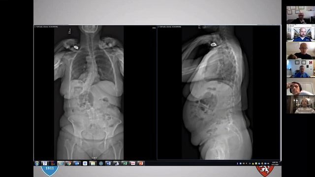 Osteoporosis and Spinal Deformity Surgery by Dr. Stuart Hershmann смотреть онлайн