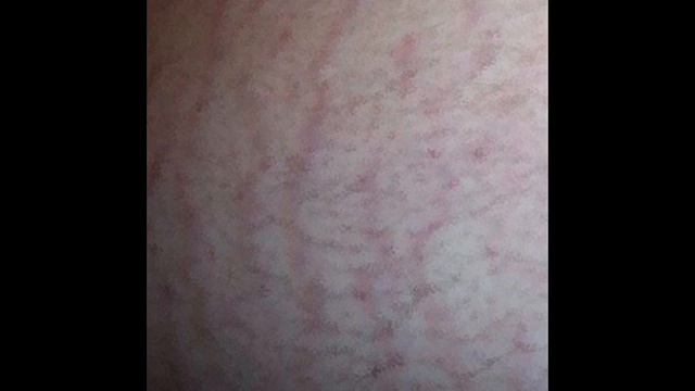 Prurigo смотреть онлайн