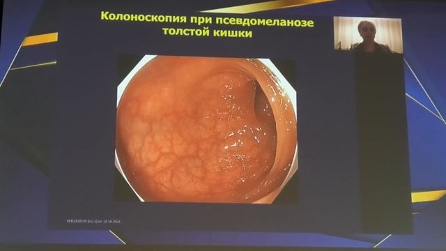 07 Иванова ЕВ Хронические запоры и колоноскопия смотреть онлайн