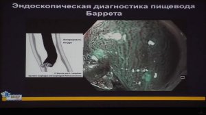 25 Видяева НС Пищевод Барретта