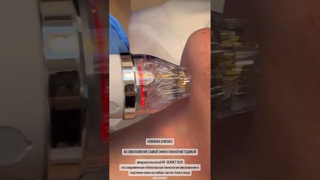 Микроигольчатый РФ-лифтинг Secret RF смотреть онлайн