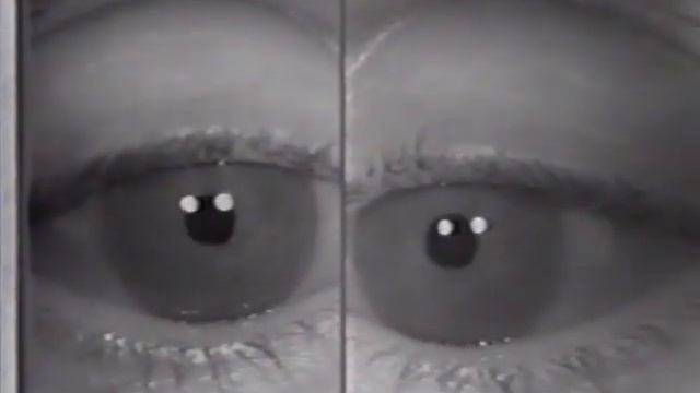 Monocular Pendular Nystagmus смотреть онлайн