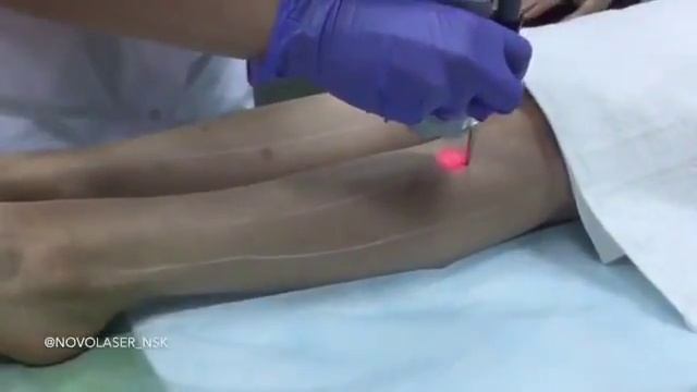 Видео отзыв NovoLASER смотреть онлайн