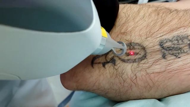 Удаление татуировки лазером смотреть онлайн