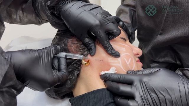 APLICAÇÃO DE RADIESSE | Efeito lifting com bioestimulador de colágeno смотреть онлайн