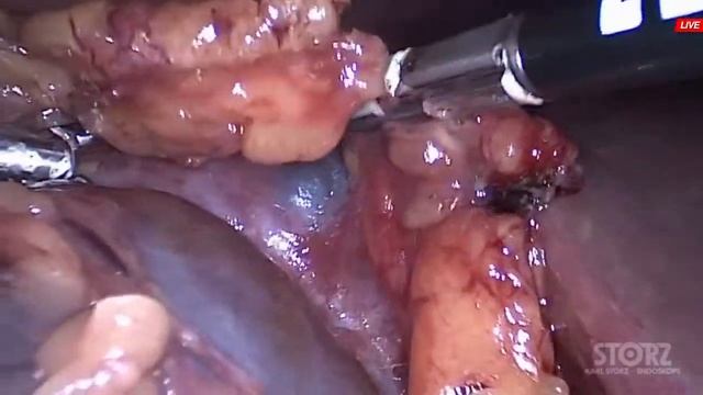 Лапароскопическое иссечение кисты почки смотреть онлайн