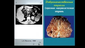 Кистозные образования поджелудочной железы