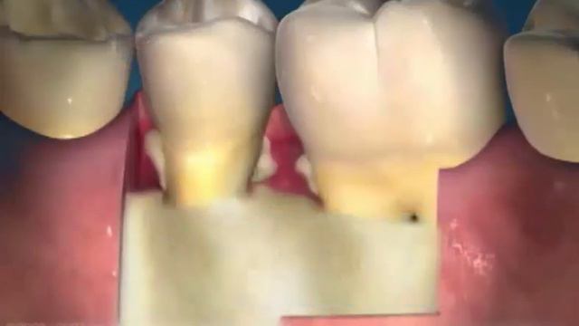 Лечение заболеваний пародонта смотреть онлайн